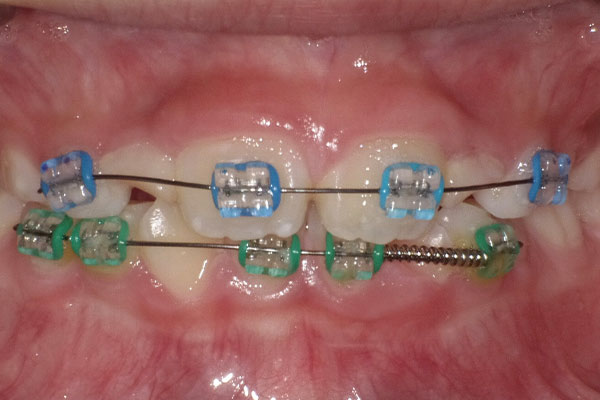 ブラケット装置